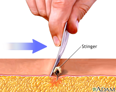 Stinger removal: MedlinePlus Medical Encyclopedia Image